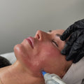 Skin Needling Package