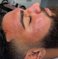 Skin Needling- Men’s Half Face