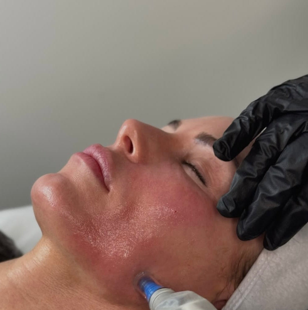 Skin Needling