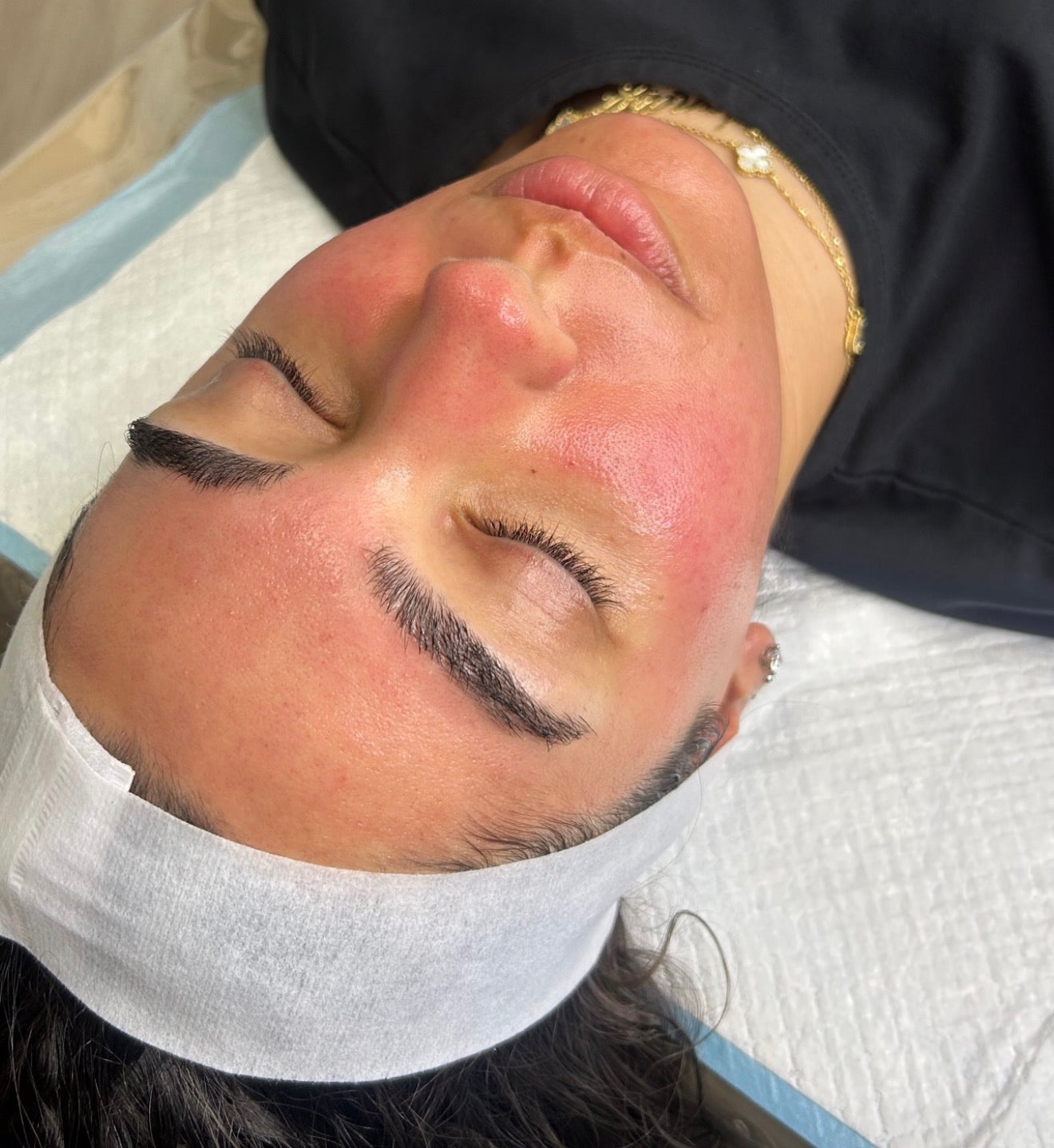 Skin Needling