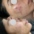 Clarifying Acne Facial